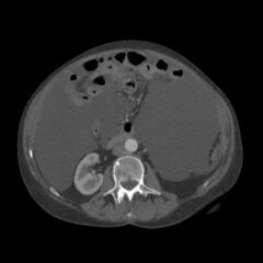 Malignant peritoneal mesothelioma as a cause of ascites