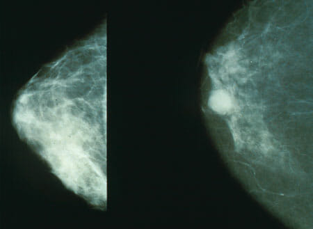Mammography breats cancer