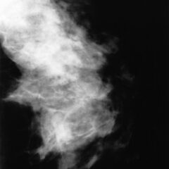 Mammogram showing fibrocystic disease