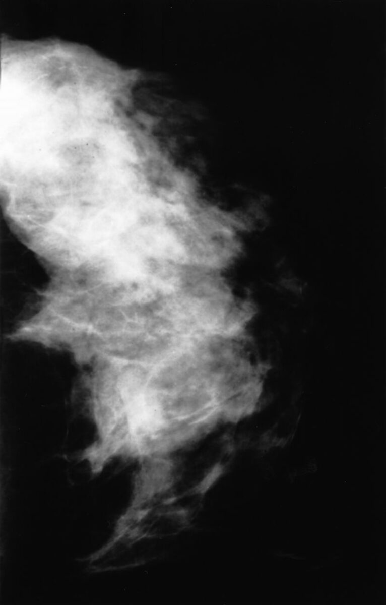 Mammogram showing fibrocystic disease Mammogram showing fibrocystic disease