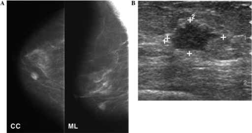 Breast Masses (Breast Lumps) - Gynecology and Obstetrics - MSD