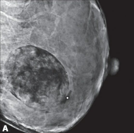 Mamografia mostrando uma massa oval contendo gordura, sugestiva de hamartoma