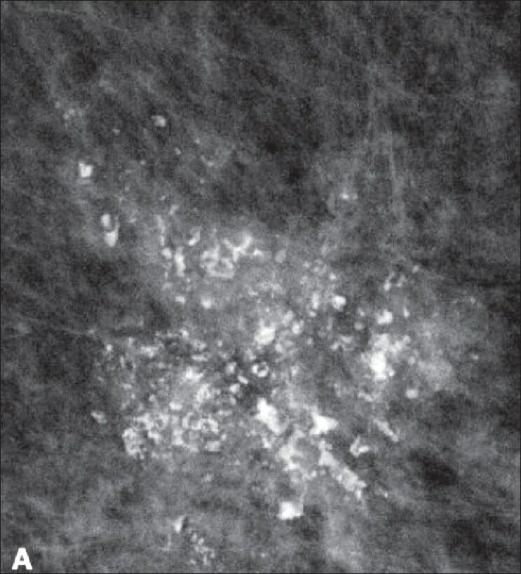Mammogram showing a group of pleomorphic microcalcifications, suggestive of breast cancer
