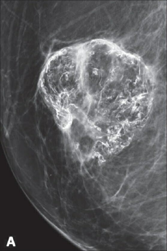 Mammogram showing coarse and eggshell calcification, suggestive of fat necrosis