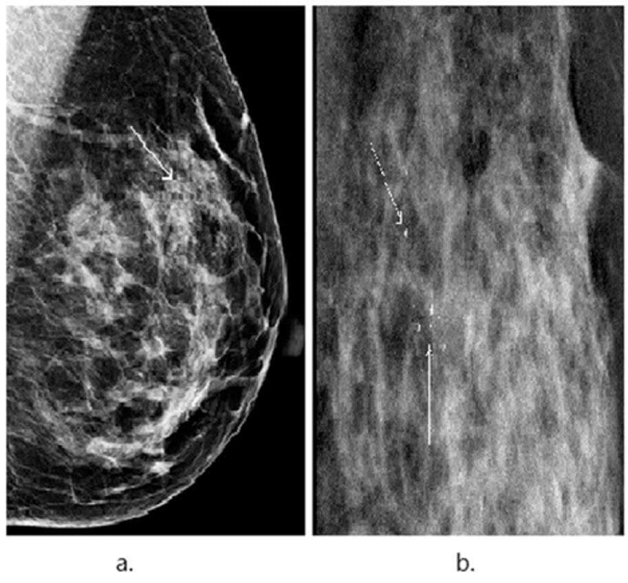 Mammogram showing focal microcalcifications