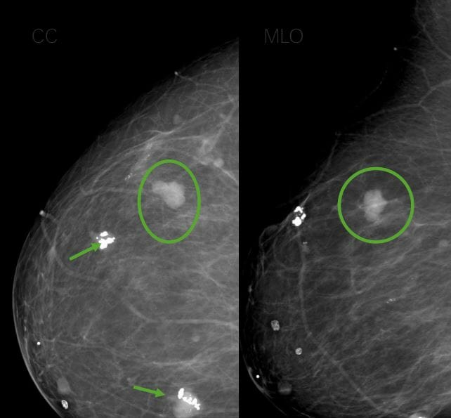 Mammogram showing popcorn calcifications