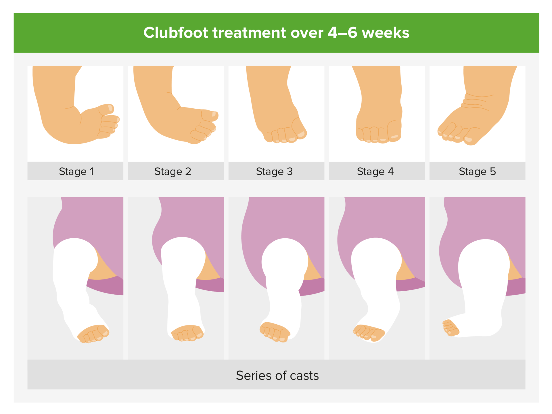 Foot Deformities Concise Medical Knowledge