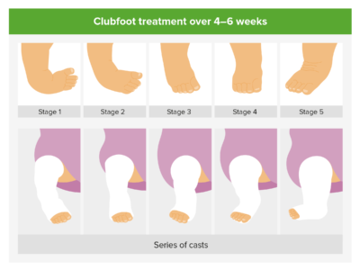 Management of clubfoot