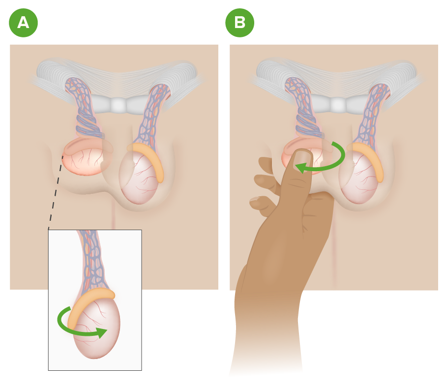 Manual testicular detorsion