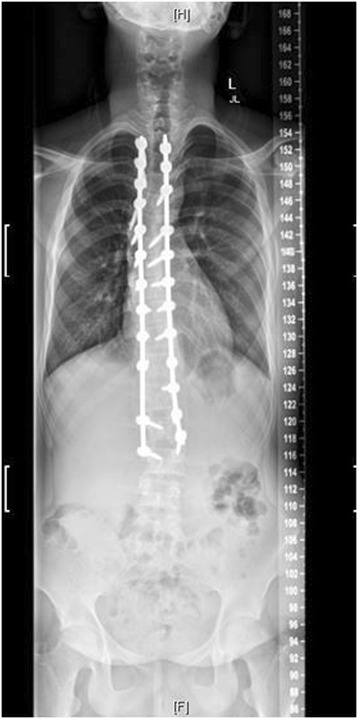 Marfan syndrome post operative radiograph