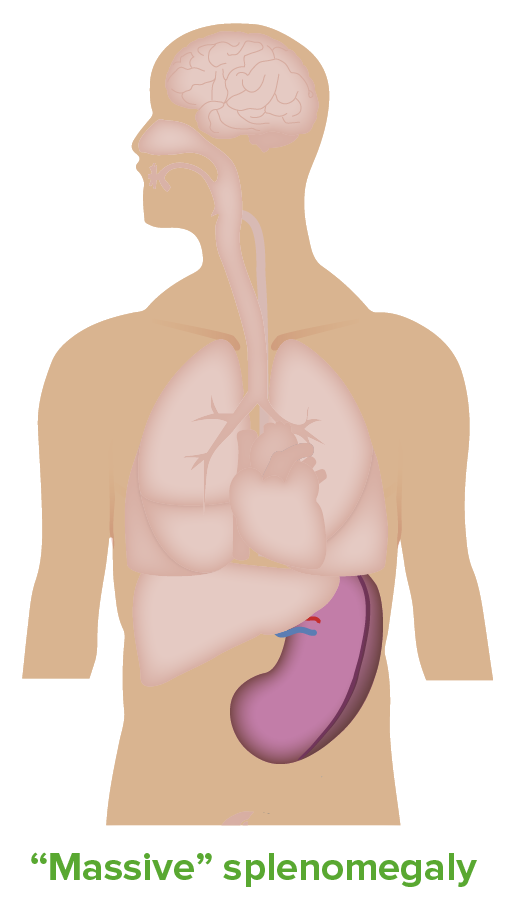 Doença de Niemann-Pick  Concise Medical Knowledge