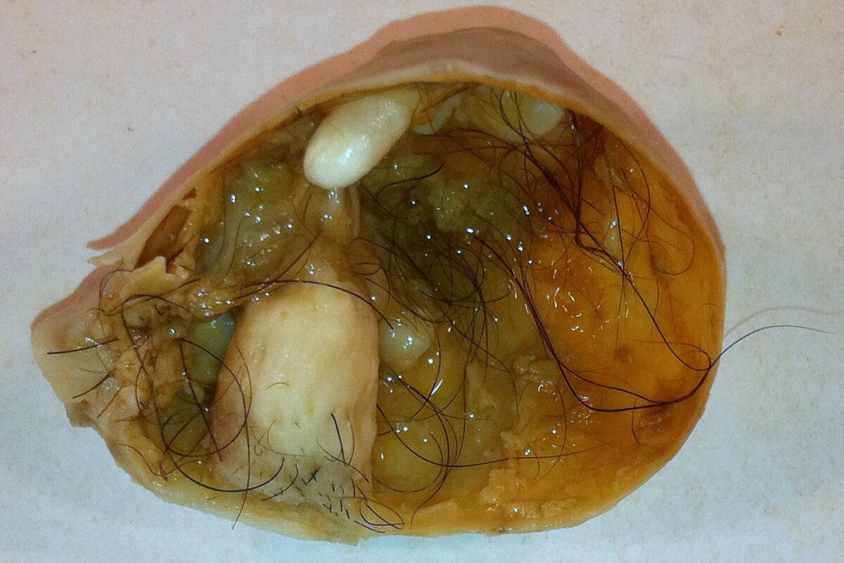 Teratoma quístico maduro