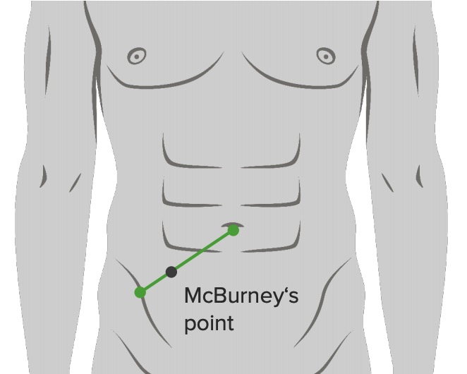 Mcburneys point illustration