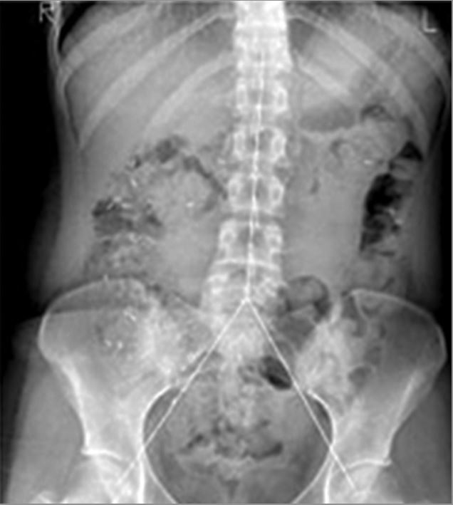 Measurement of colonic transit time based on radiopaque markers in a patient with chronic idiopathic constipation