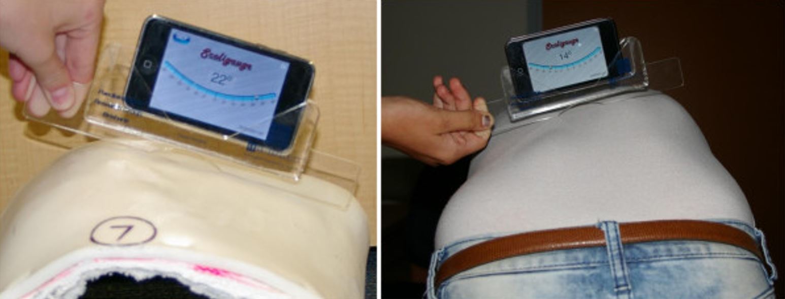 Measurement of the rib hump on a plaster model and a scoliosis patient