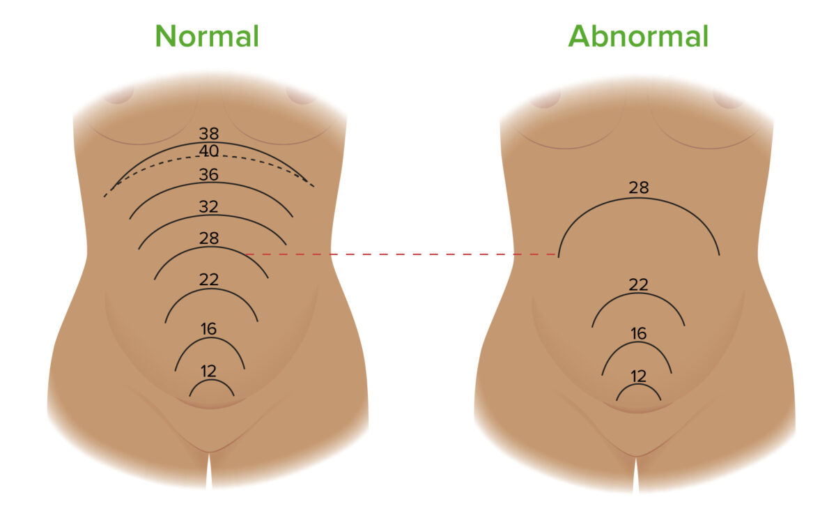 Measurement of fundal height