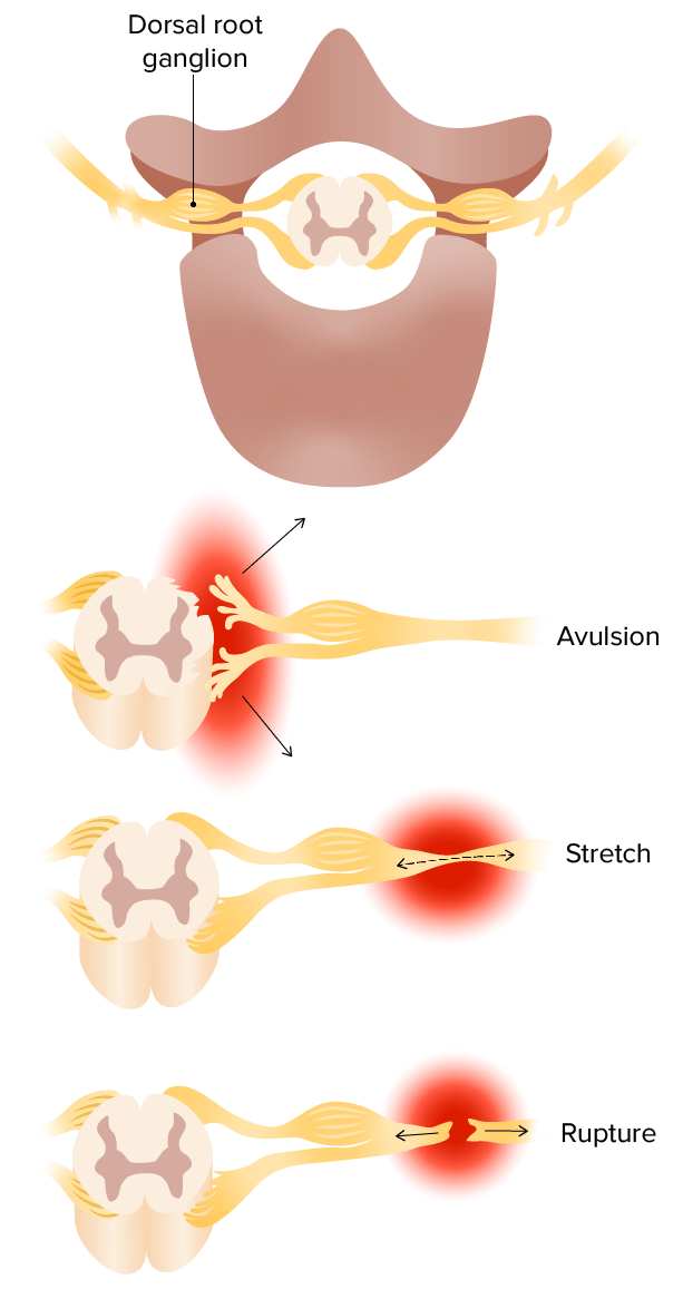 Mechanisms of brachial plexus injury
