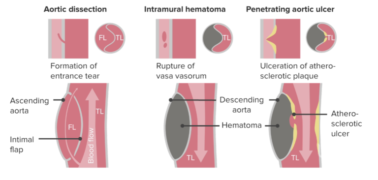 Aortic Dissection | Concise Medical Knowledge