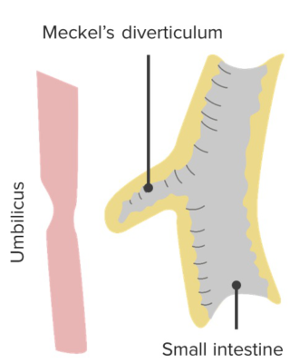 Meckels Diverticulum Concise Medical Knowledge 