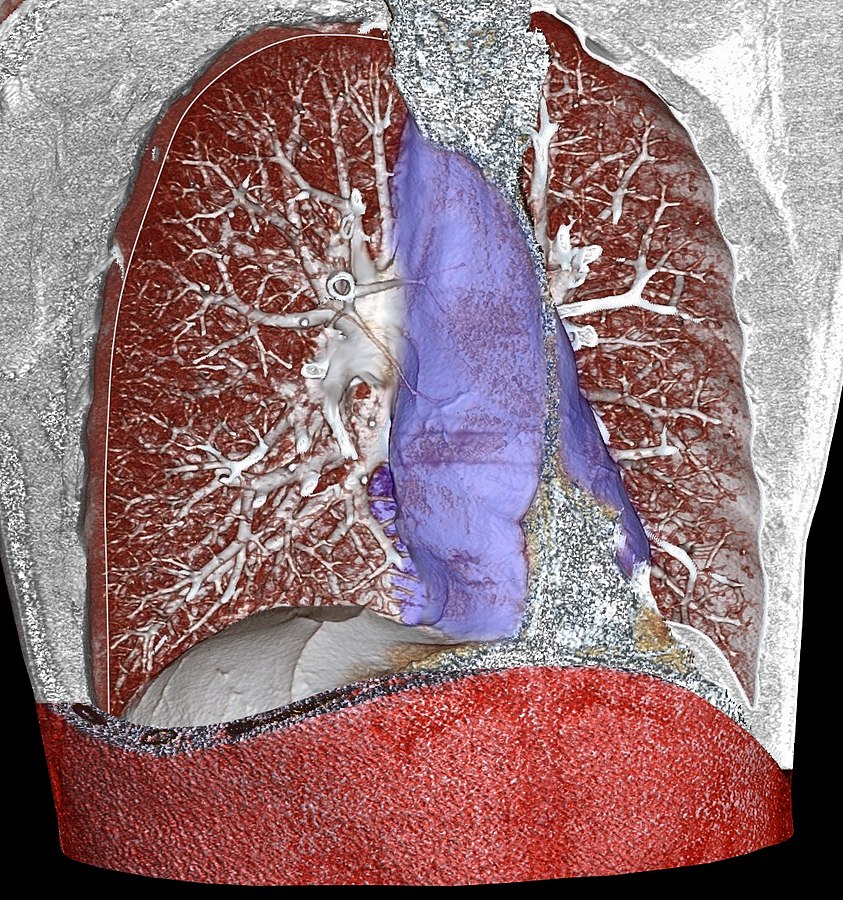 Thoracic Outlet Syndrome  Concise Medical Knowledge