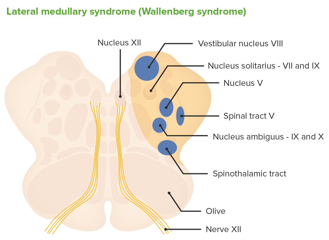 Medullary syndrome (wallenberg syndrome)