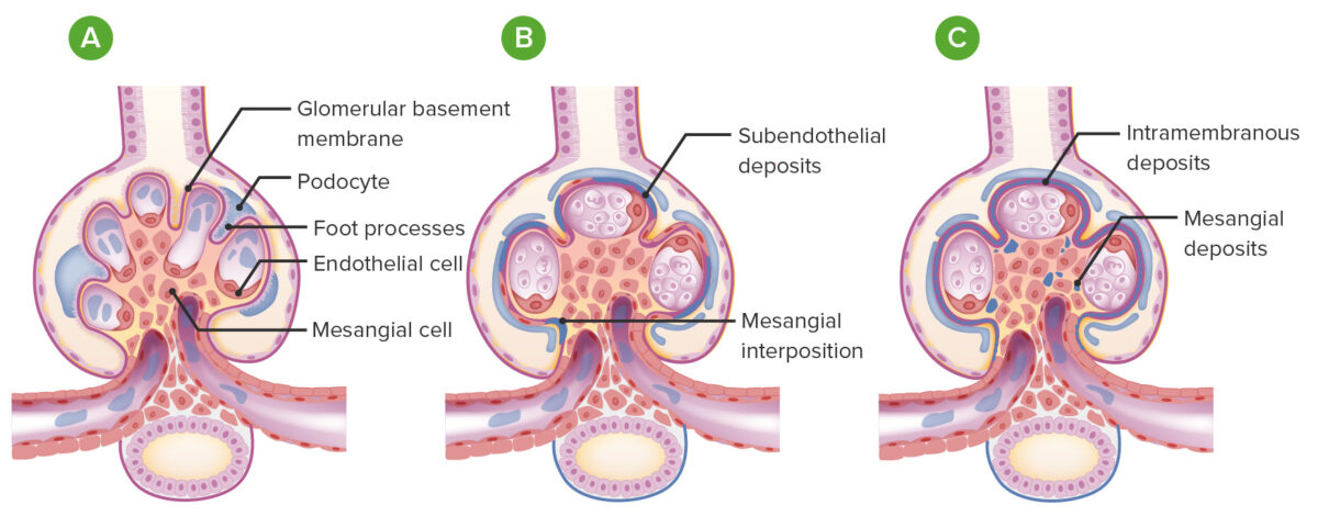 Membranoproliferative glomerulonephritis (mpgn) vs normal glomeruli