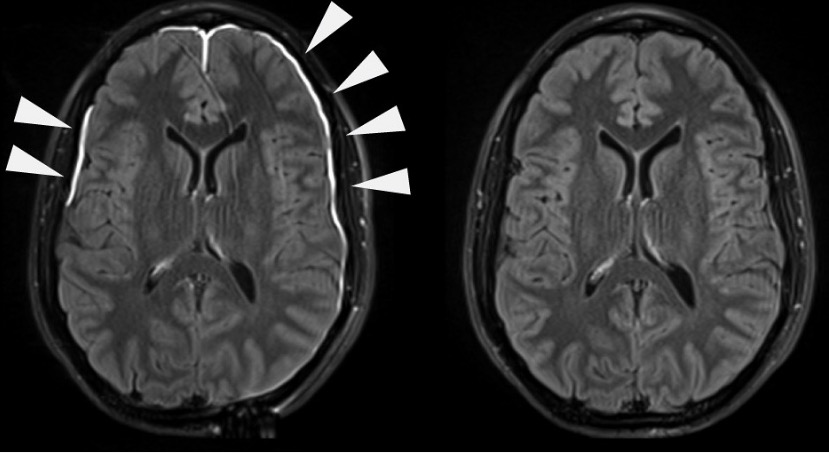 meningitis bacteriana resonancia magnética cerebral