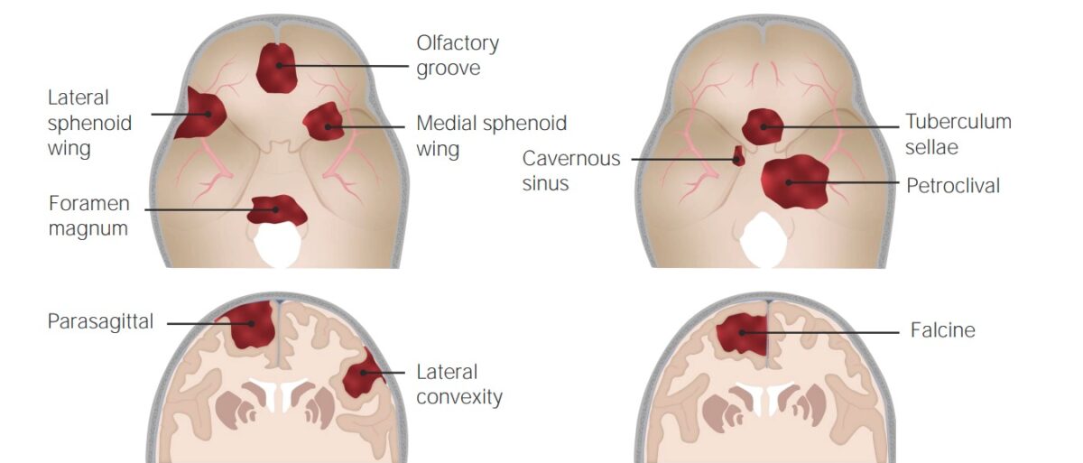 Localizações dos meningiomas