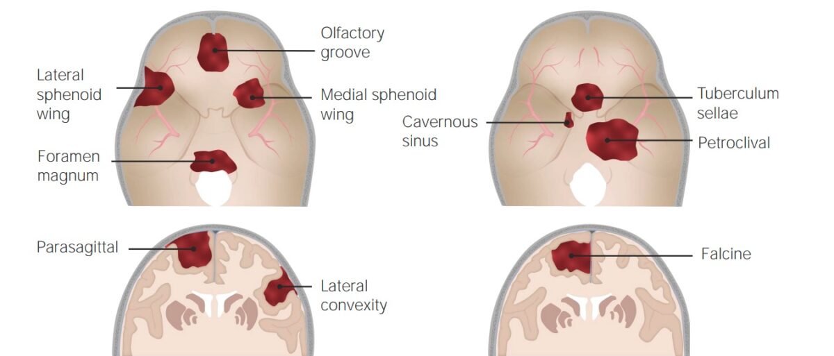 Meningioma locations