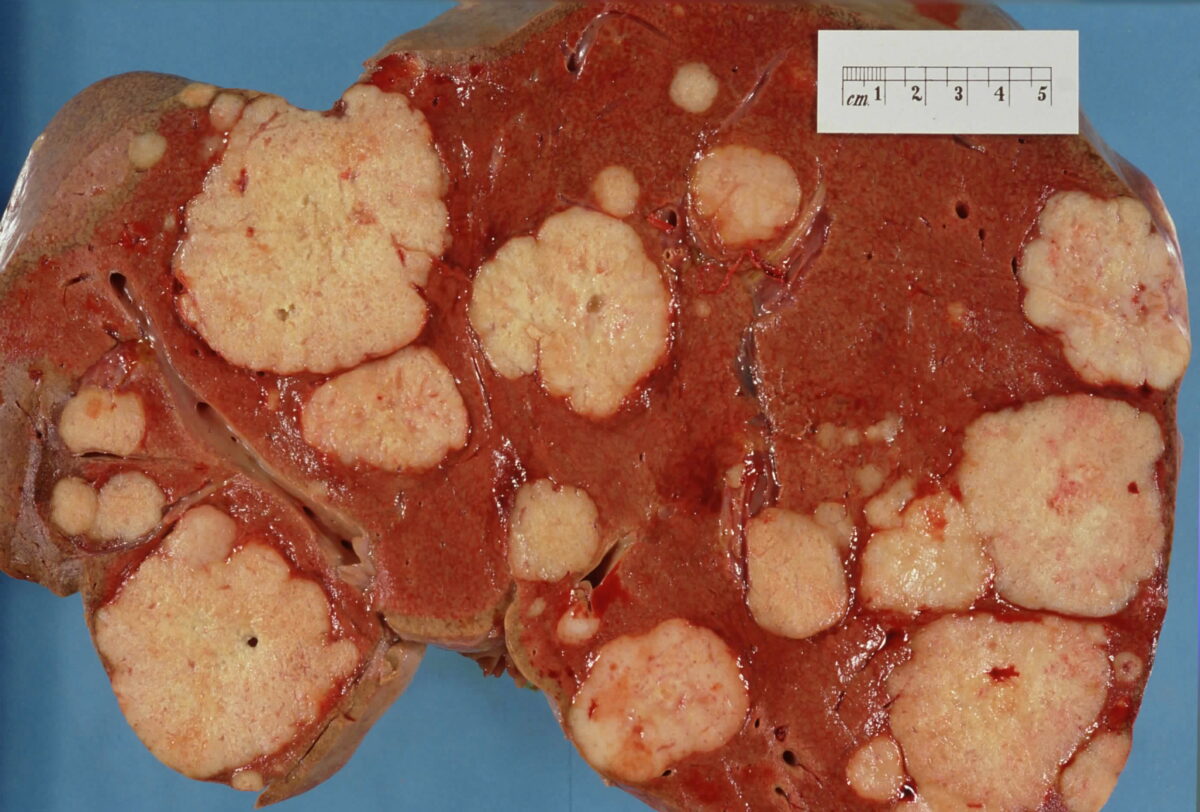 Metastases in the liver