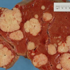 Metastases in the liver