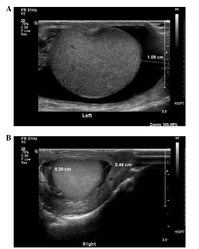 Metastatic testicular tumor presenting as a scrotal hydrocele