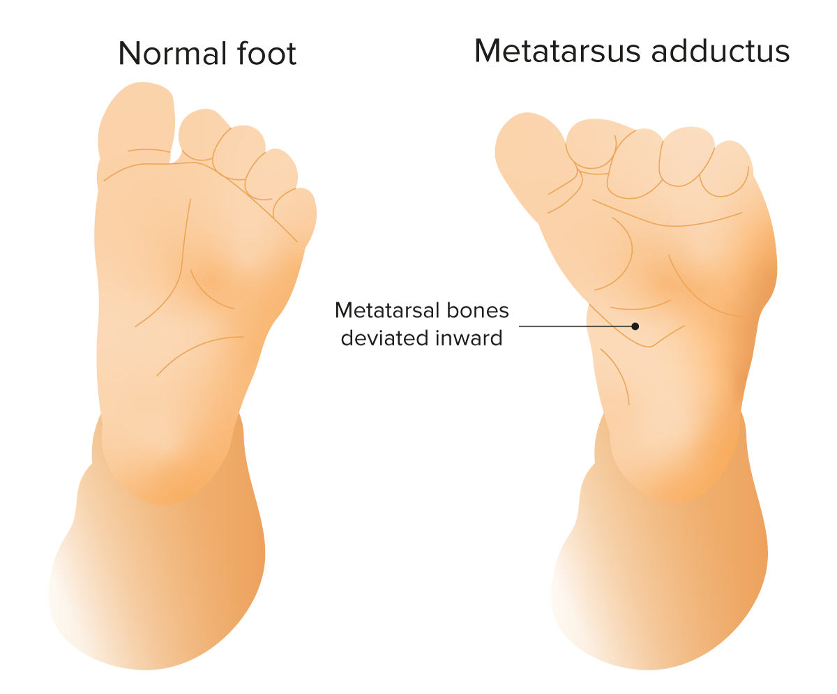 Curved Foot or Metatarsus Adductus – Clark Podiatry Center