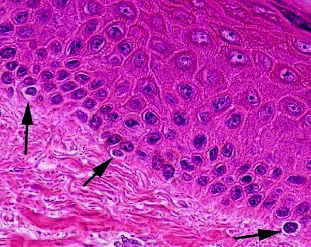 Micrograph of melanocytes in the epidermis
