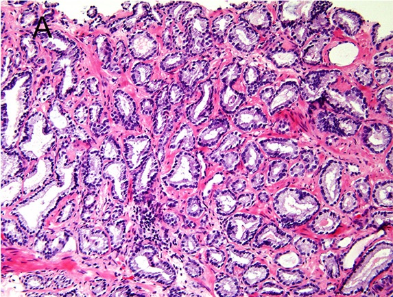 Micrograph of prostate cancer with gleason score 6 (3+3)