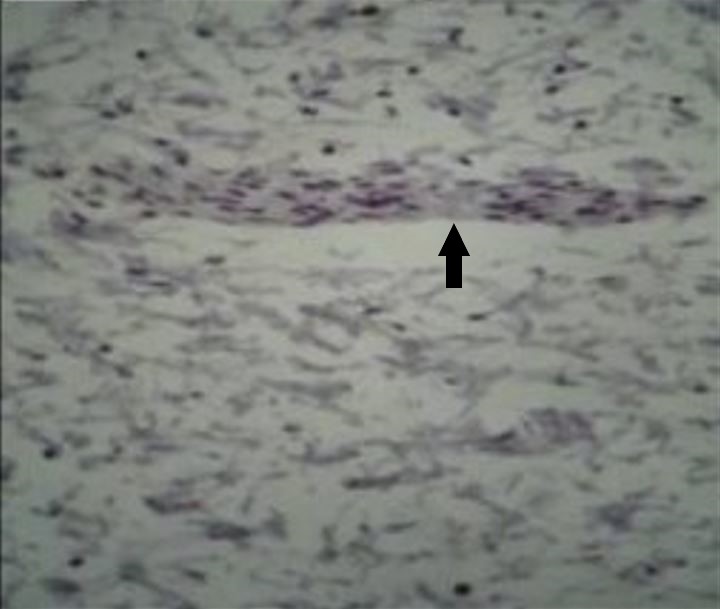 Microphotograph of an hd-affected segment of intestine