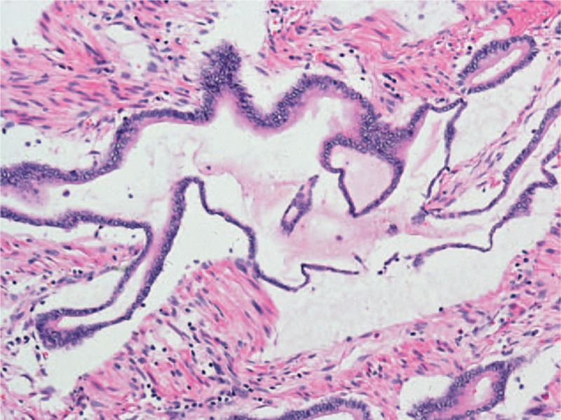 Microphotograph of pancreatic mucinous adenocarcinoma