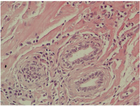 acute prostatitis uptodate)