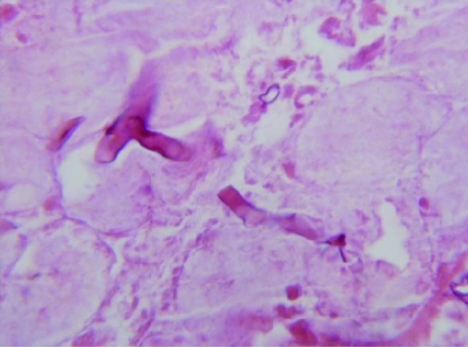 Visão microscópica da mucormicose da amostra de biópsia
