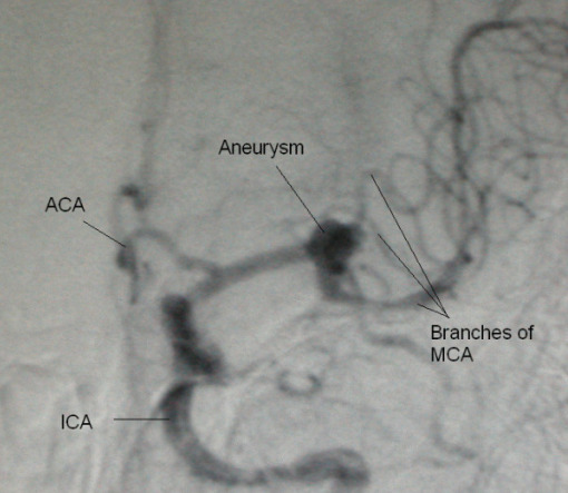 Middle cerebral artery aneurysm angiogram
