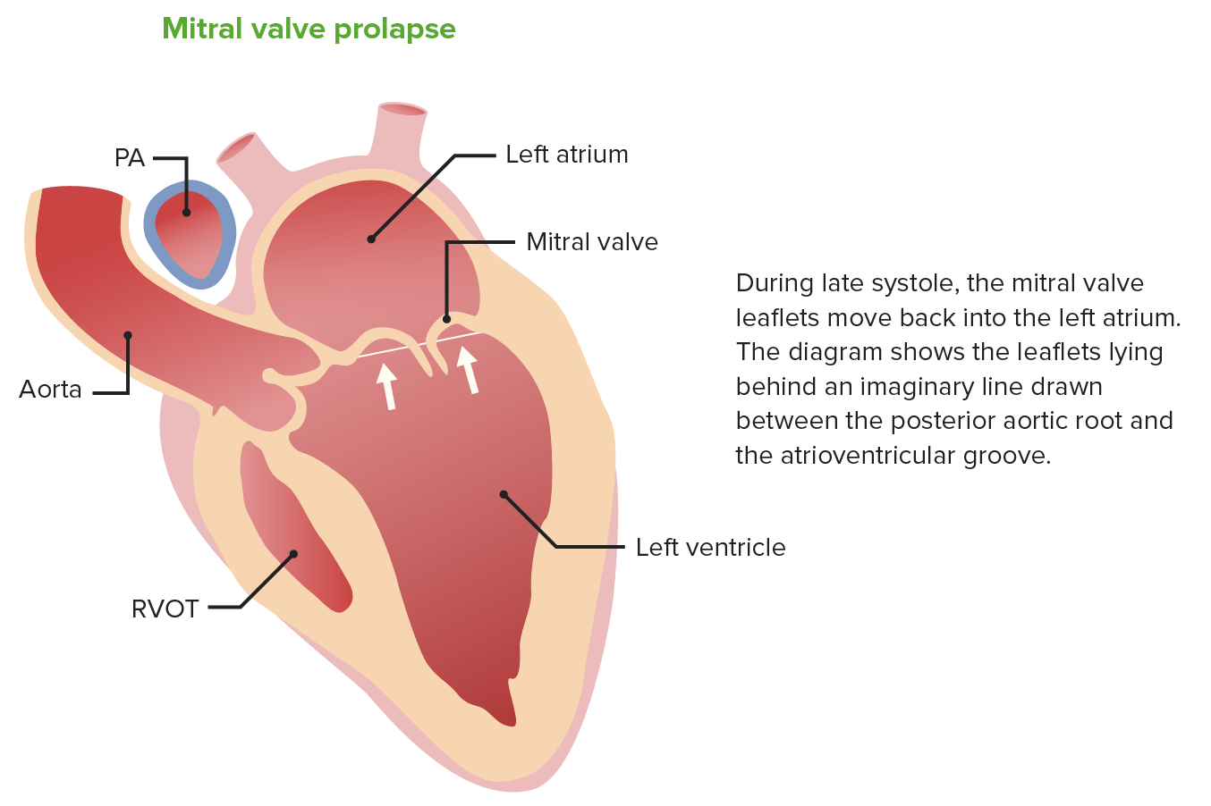 mitral valve prolapse adalah