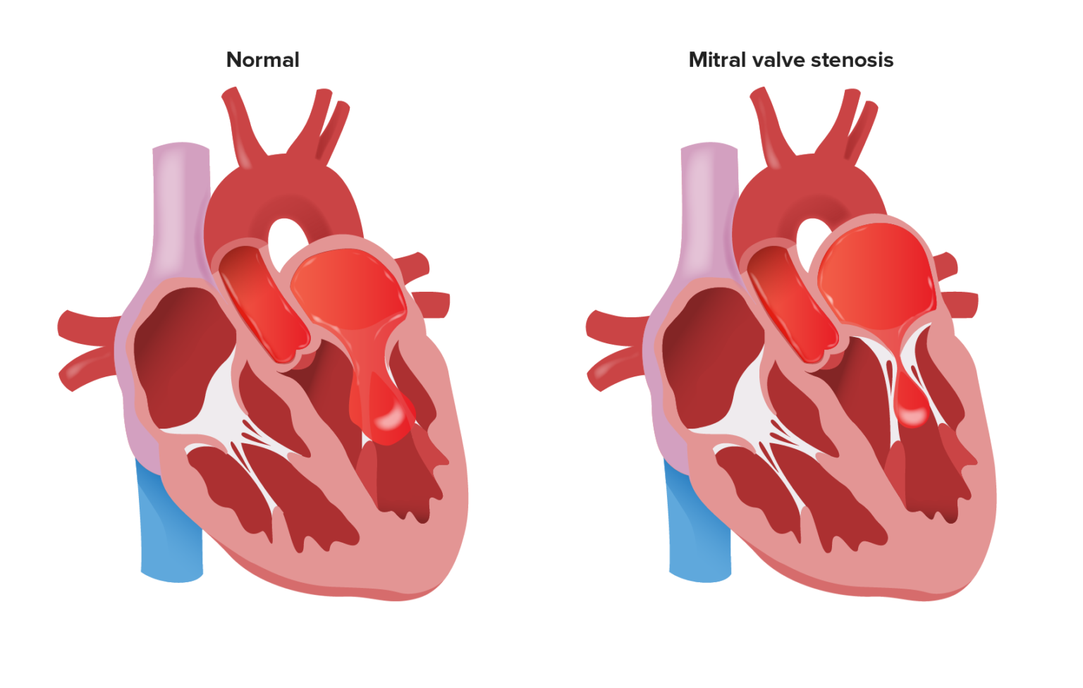 Mitral Stenosis | Concise Medical Knowledge
