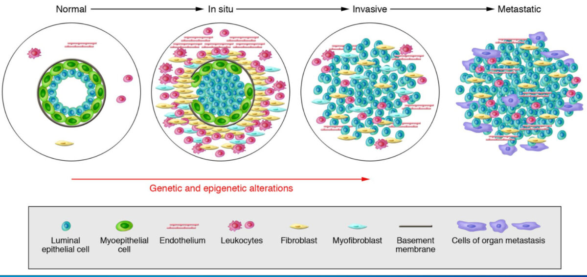 Model of breast tumor progression