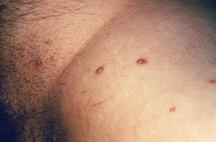 papilloma condyloma negii molluscum contagiosum sárgaság vérszegénység