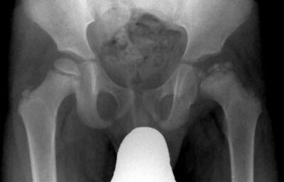 Morbus perthes x-ray