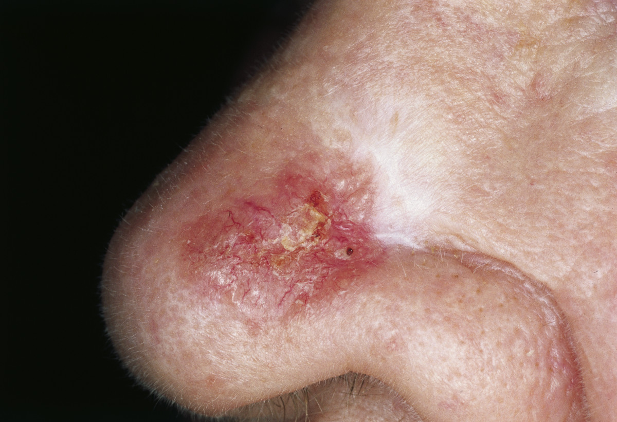 Morpheaform basal cell carcinoma