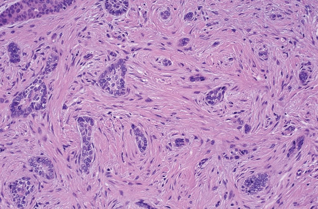 Morpheaform basal-cell carcinoma