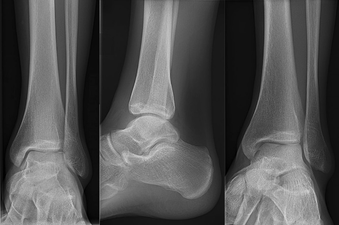 Mortise (left), lateral (middle), and anterior-posterior view (right) of a normal right ankle