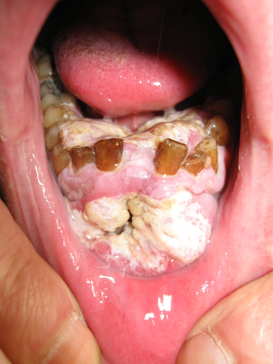 Mouth cancer in a male smoker
