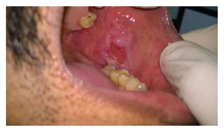 Mucosal erosion due to pemphigus vulgaris